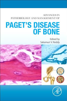 Advances in Pathobiology and Management of Paget's Disease of Bone - Reddy, Sakamuri V., PhD (Editor)