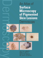 An Atlas of Surface Microscopy of Pigmented Skin Lesions: Dermoscopy