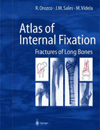 Atlas of Internal Fixation: Fractures of Long Bones