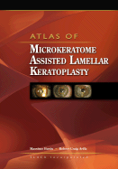 Atlas of Microkeratome Assisted Lamellar Keratoplasty