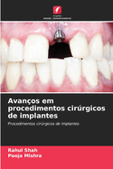 Avan?os em procedimentos cirrgicos de implantes