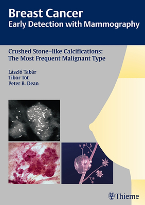 Breast Cancer: Early Detection with Mammography: Crushed Stone-like Calcifications: The Most Frequent Malignant Type - Tabar, Laszlo, and Tot, Tibor, and Dean, Peter B.