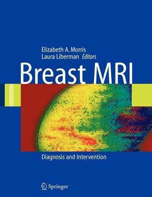 Breast MRI: Diagnosis and Intervention - Liberman, Laura (Editor)