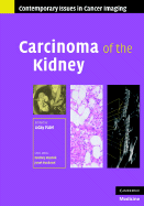 Carcinoma of the Kidney - Patel, Uday (Editor)