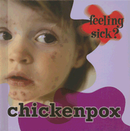 Chickenpox