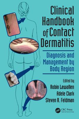 Clinical Handbook of Contact Dermatitis: Diagnosis and Management by Body Region - Lewallen, Robin (Editor), and Clark, Adele (Editor), and Feldman, Steven R, MD, PhD (Editor)