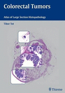 Colorectal Tumors