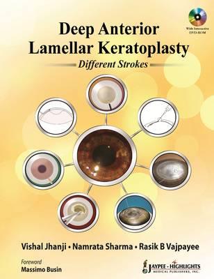Deep Anterior Lamellar Keratoplasty Different Strokes - Jhanji, Vishal (Editor), and Sharma, Namrata (Editor), and Vajpayee, Rasik B (Editor)