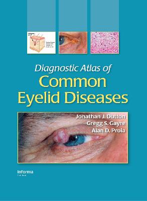 Diagnostic Atlas of Common Eyelid Diseases - Dutton, Jonathan J, and Gayre, Gregg S, and Proia, Alan D