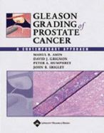 Gleason Grading of Prostate Cancer: A Contemporary Approach - Amin, Mahul B, MD, and Grignon, David J, MD, and Humphrey, Peter A, MD, PhD