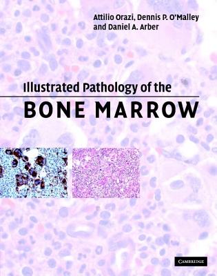 Illustrated Pathology of the Bone Marrow - Orazi, Attilio, MD, and O'Malley, Dennis P, and Arber, Daniel A
