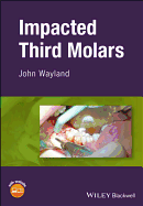 Impacted Third Molars