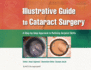 Illustrative Guide to Cataract Surgery: a Step-By-Step Approach to Refining Surgical Skills (Hb 2011)