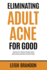 Eliminating Adult Acne for Good