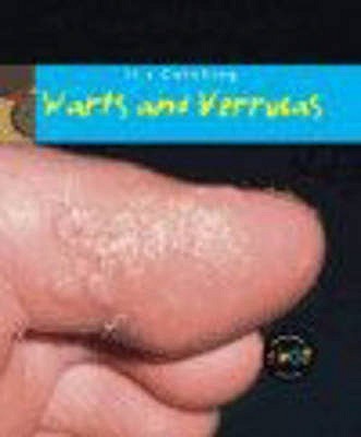 It's Catching: Warts and Verrucas - Royston, Angela