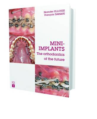 Mini-Implants: The Orthodontics of the Future - Ellouze, Skander, and Darque, Francois