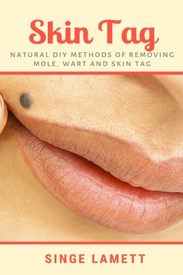 Skin Tag: Natural DIY Methods of removing Mole, Wart and Skin Tag - Lamett, Singe