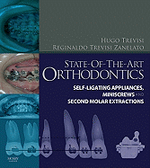 State-of-the-art Orthodontics: Self-ligating Appliances, Miniscrews and Second Molars Extraction