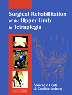 Surgical Rehabilitation of the Upper Limb in Tetraplegia