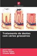 Tratamento de dentes com cries grosseiras