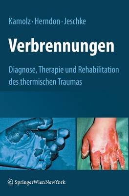 Verbrennungen: Diagnose, Therapie Und Rehabilitation Des Thermischen Traumas - Kamolz, Lars-Peter (Editor), and Herndon, David N, MD, Facs (Editor), and Jeschke, Marc G (Editor)