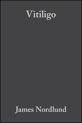Vitiligo: A Monograph on the Basic and Clinical Science - Nordlund, James (Editor)