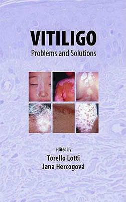 Vitiligo - Lotti, Torello (Editor), and Hercogova, Jana (Editor)